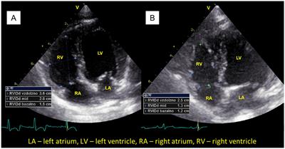 Echocardiographic analysis of dogs before and after surgical treatment of brachycephalic obstructive airway syndrome